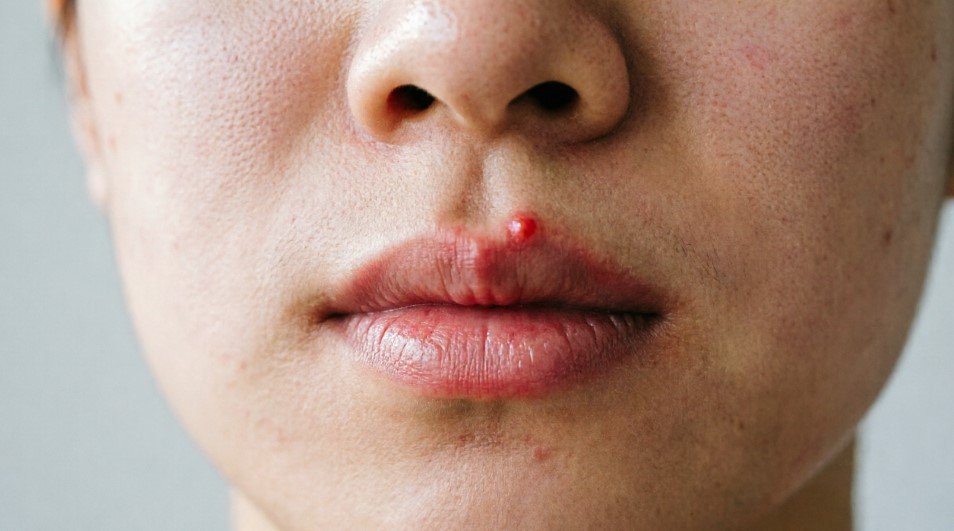a pimple on your lip
